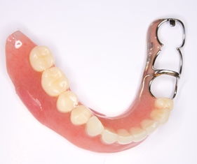 テレスコープ義歯と他の治療方法との違い