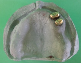 歯肉全体を覆う形の入れ歯をはめます