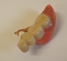 片側リーゲル義歯開-1