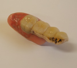 片側リーゲル義歯閉-1