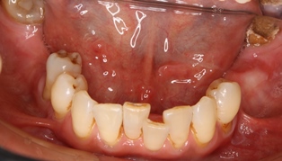 両側リーゲル初診義歯なし-1.jpg