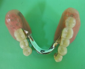 両側リーゲル新義歯-1.jpg