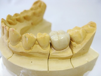 セラミック製の白い歯