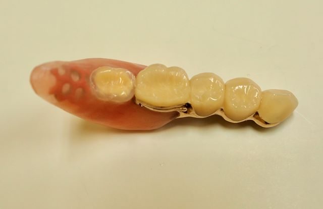 ドイツ式部分入れ歯 テレスコープ義歯
