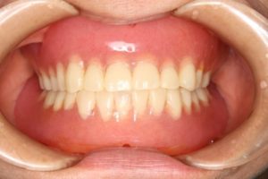レジリエンツテレスコープ義歯の治療