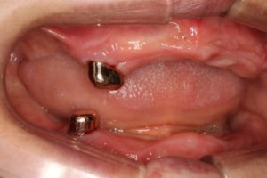 レジリエンツテレスコープ義歯の治療