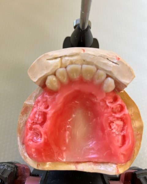 ドイツ式の義歯