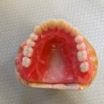 当院で行っているドイツ式の義歯（２）