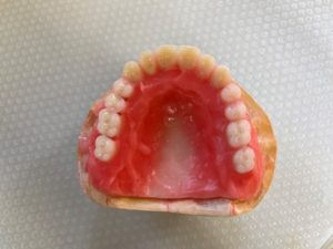当院で行っているドイツ式の義歯（２）