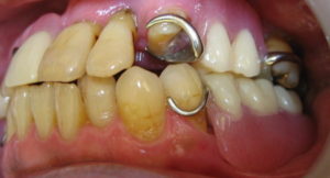 治療を始める前のお口の状態