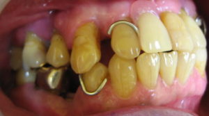 治療を始める前のお口の状態