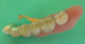 片顎タイプのリーゲルテレスコープ義歯