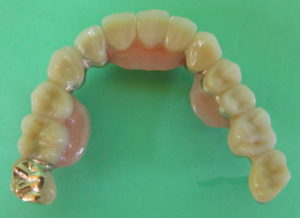 上顎 顎タイプのコーヌステレスコープ義歯