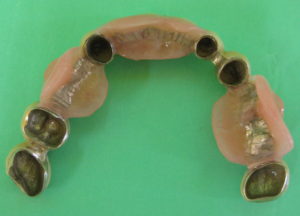 上顎 顎タイプのコーヌステレスコープ義歯