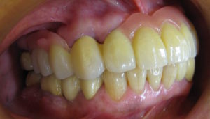 治療後のお口の状態