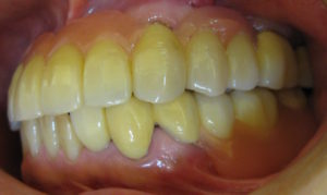 治療後のお口の状態