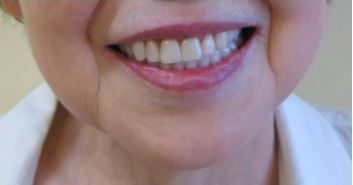 上顎に総義歯、下顎にテレスコープ義歯をはめたところ