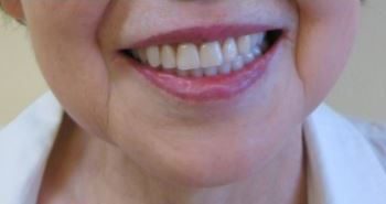 数本歯が残っている〜無歯顎までの義歯治療