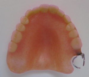 一般的な大きい範囲のバネ式（クラスプ）入れ歯