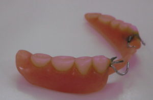 金属クラスプ（バネ）の入れ歯