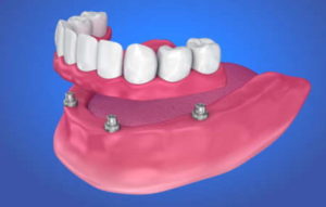 テレスコープ入れ歯とインプラント入れ歯では何が違う？（総義歯に近い入れ歯の場合）