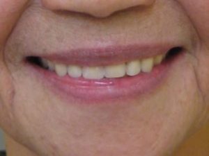 実際の治療例をご紹介（歯が数本しか残っていない方の治療）