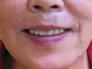 実際の治療例をご紹介（総義歯治療２）