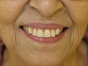 実際の治療例をご紹介（歯が数本しかない場合の義歯治療２）