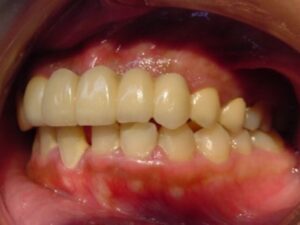 交通事故で前歯が数本折れた場合のセラミックブリッジ治療