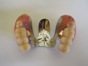 上下顎のテレスコープ義歯治療